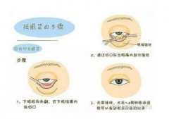 激光和內(nèi)切祛眼袋哪個更持久?